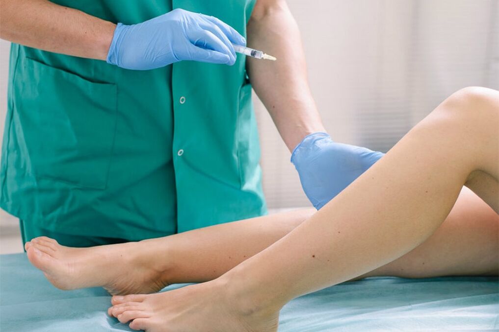 skleroterapia na odstránenie kŕčových žíl